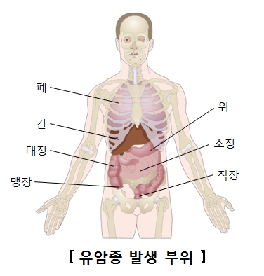 직장유암종