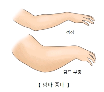 임파종대