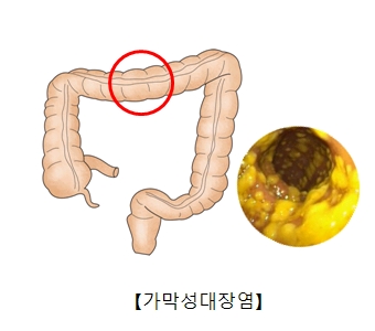 가막성대장염