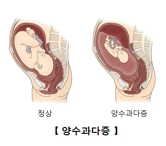 양수과다증