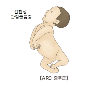 ARC 증후군