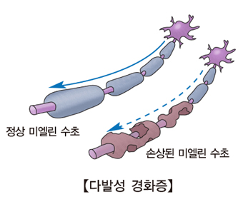 다발성 경화증