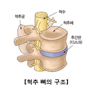 요추 추간판 탈출증