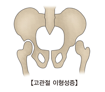 변형성 고관절증