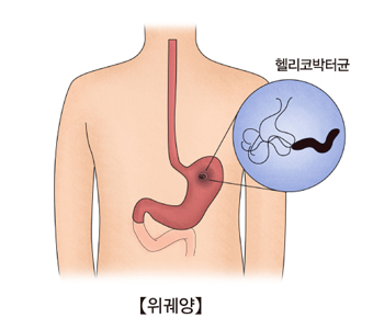 헬리코박터균 감염