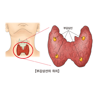 부갑상선 기능항진증