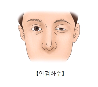 눈꺼풀 장애