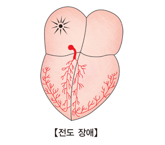 전도 장애