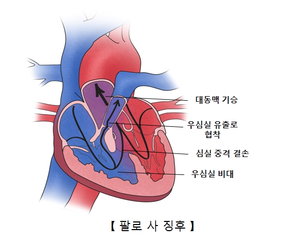 팔로 사 징후