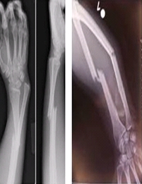 원위요골과 척골 골절
