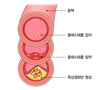 죽상경화증