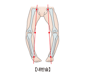 구루병