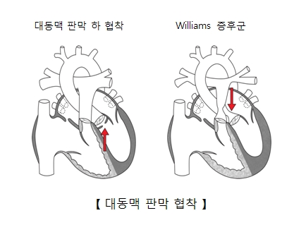 대동맥 협착