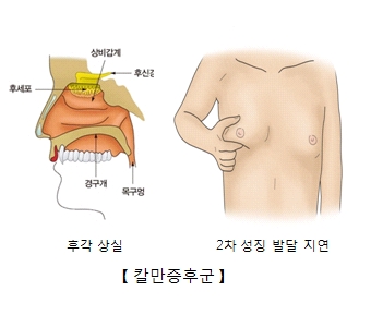 칼만증후군