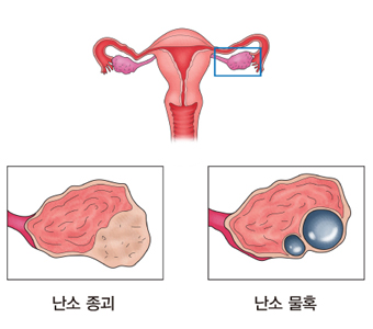 난소난증