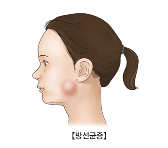 방선균증