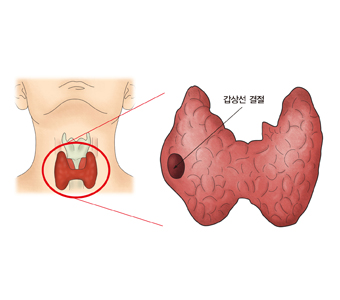 갑상선 결절