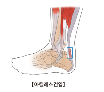 아켈리스 건 파열