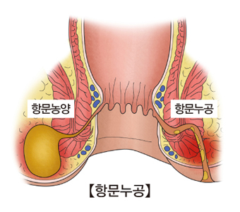 항문누공