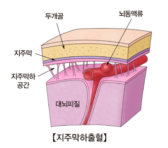 지주막하출혈