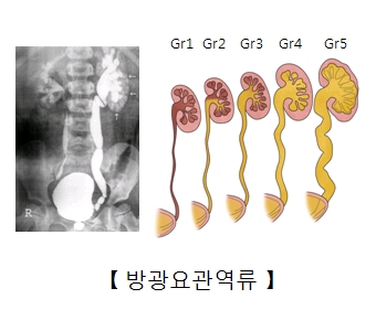 선천성 수신증