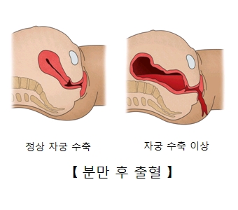 분만후 출혈