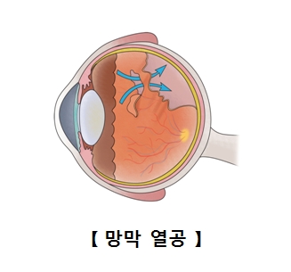 망막열공