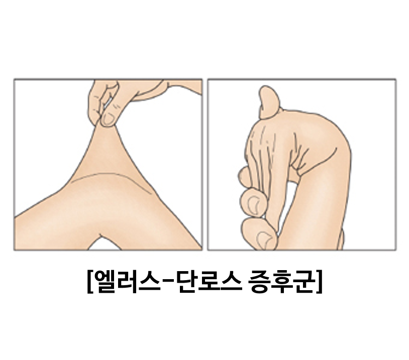 엘러스-단로스 증후군