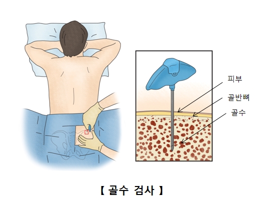 골수검사