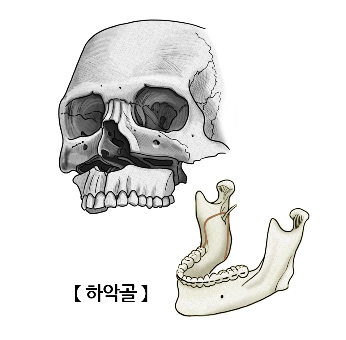 하악골